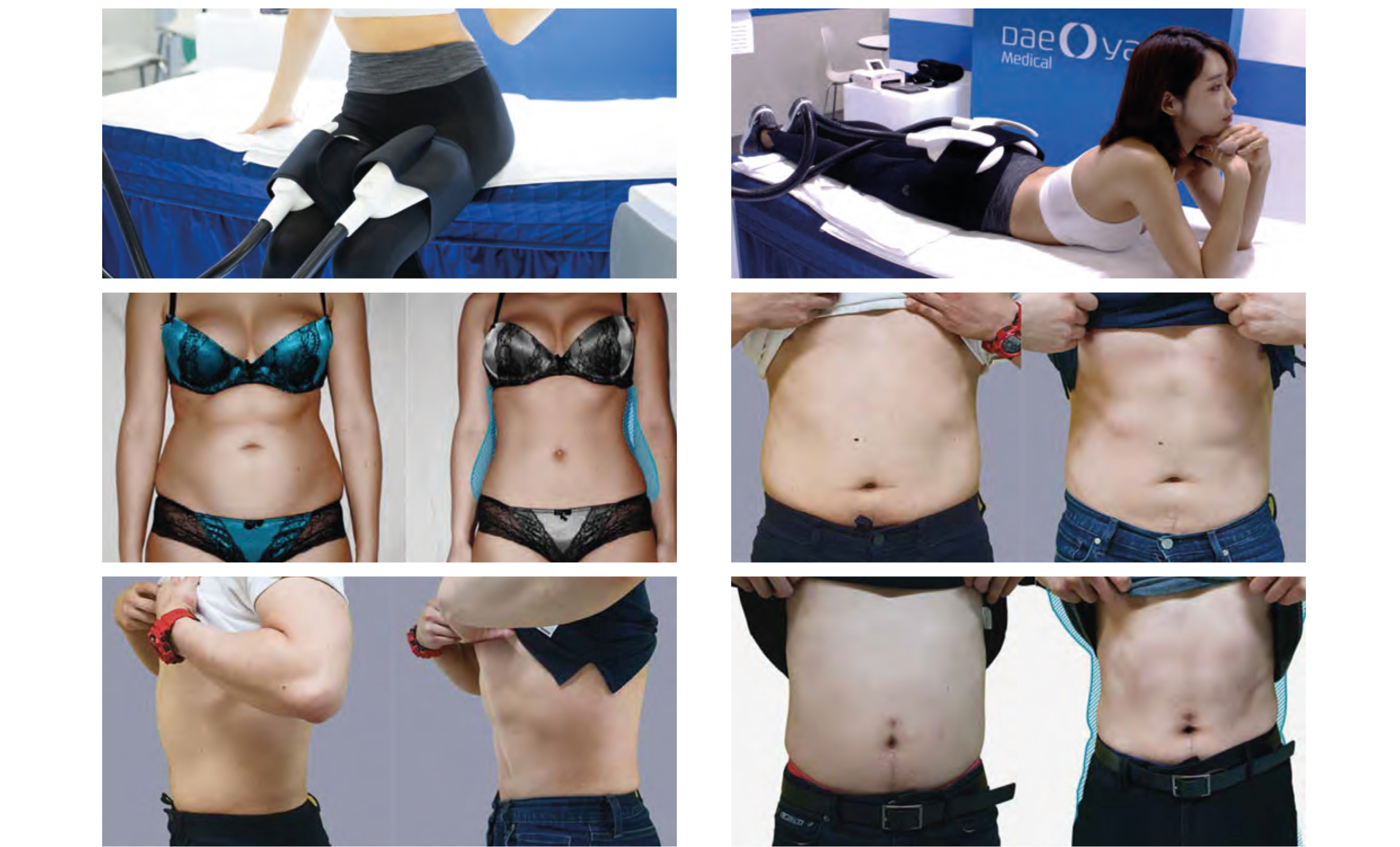 CM Slim in 6 Sitzungen